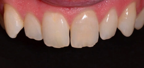 full smile makeover