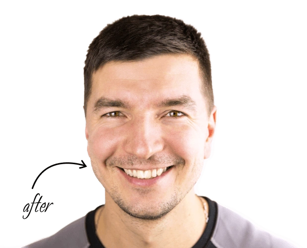 smile-after-img