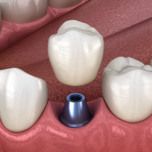 6571e068154d757f908af450_dental-crowns-and-dental-bridges-2107