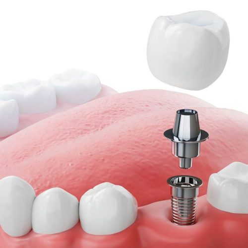 Crown-Placement-1024x677