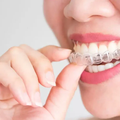 change-invisalign-aligners