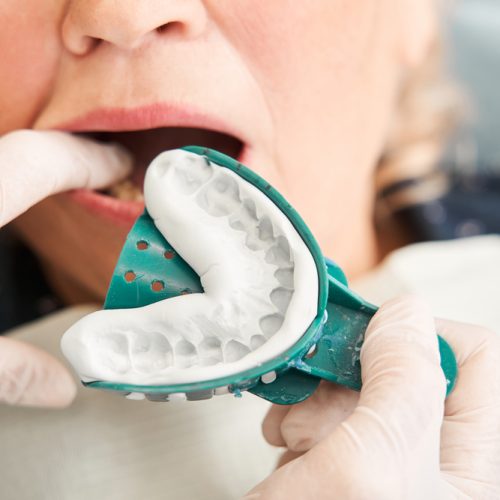 Cropped view of the hands of professional prosthetic technician wearing protective gloves sitting near the patient in her office and putting dental impression for dentures to the client mouth