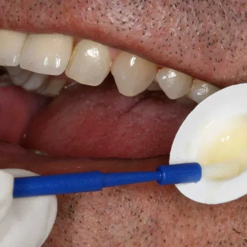 fluoride-varnish-vs-fluoride-foam